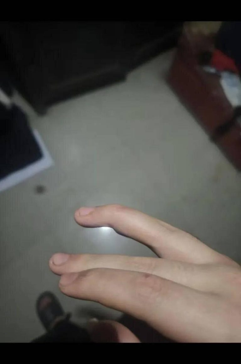 小豪被打到右手手指骨折、韧带断裂，至今难以伸直。  （取材自南方都市报）