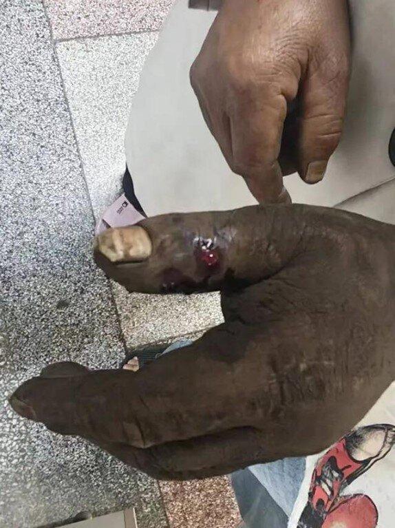 患者被毒蛇咬伤之后的手。(取材自人民网/红河州第三人民医院提供)