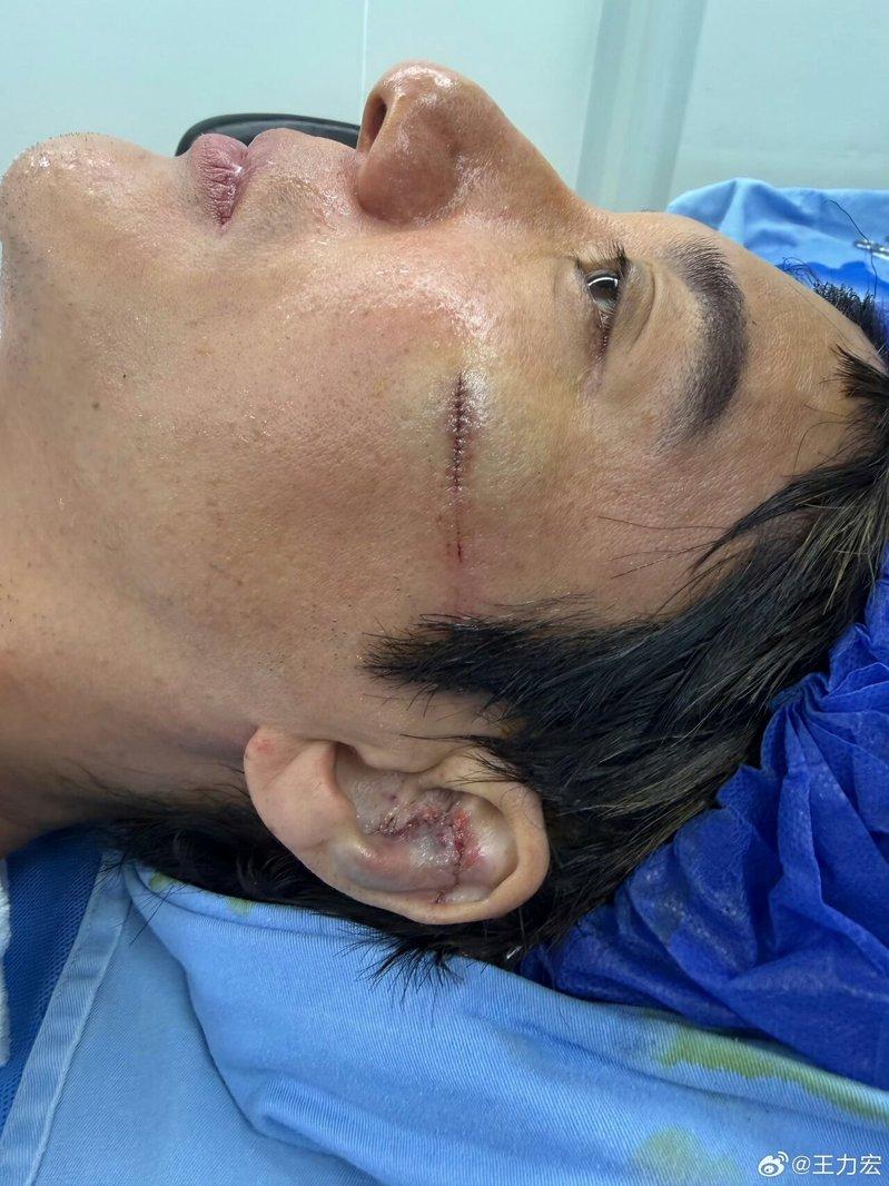 王力宏摔伤共计缝了39针。(取材自微博)
