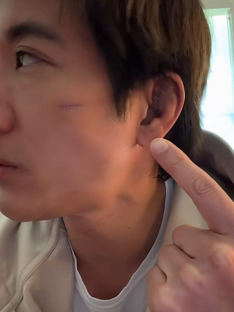 王力宏表示摔伤伤口恢复得差不多了。(取材自微博)