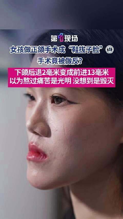 武汉24岁女子小雨下颌术后变成前移13毫米,脸型恶化成「鞋拔子脸」。(视频截屏)