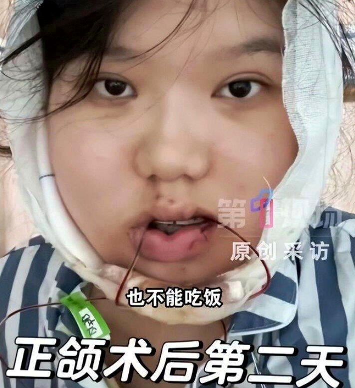 武汉24岁女子小雨接受正颌手术第二天模样。(视频截屏)