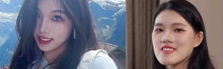 惨变「鞋拔子」…武汉24岁女正颌手术被做反 涉事医遭停职 武汉24岁女子小雨正颌手术被做反,导致脸形明显改变。(视频截屏)