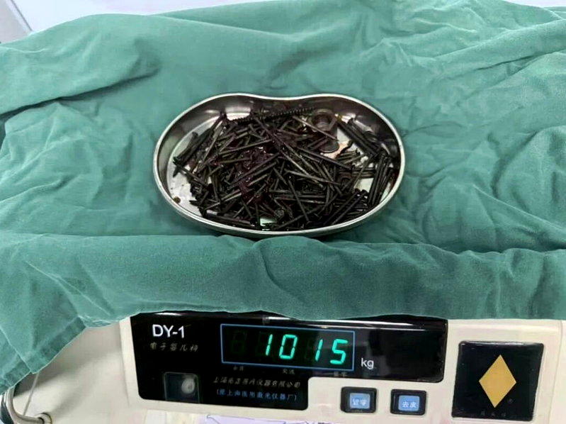云南一名36岁男子胃内塞满大量金属异物,医师手术取出181颗铁钉及其他异物,总重...