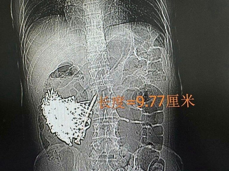 胃里塞满181颗铁钉 云南36岁男手术取出近1公斤金属异物 云南一名36岁男子因反复恶心、呕吐9天就医,检查发现其消化道内布满大量金属异物,...