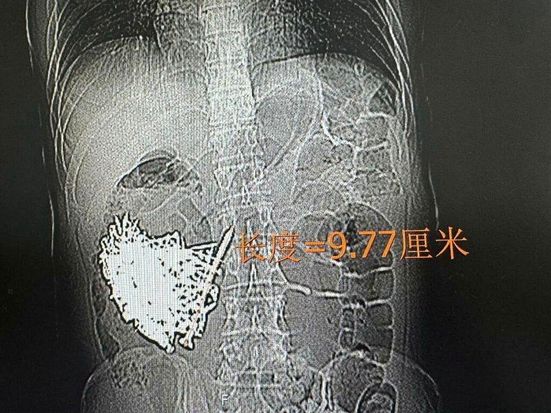 云南一名36岁男子因反复恶心、呕吐9天就医,检查发现其消化道内布满大量金属异物,...