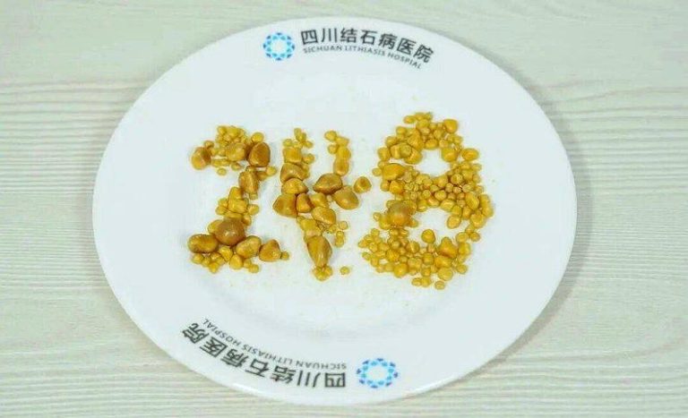 26岁男三餐吃外卖 胆囊248颗结石 医:炸鸡、烤肉少吃 从江先生胆囊内取出的结石。(取材自环球网)