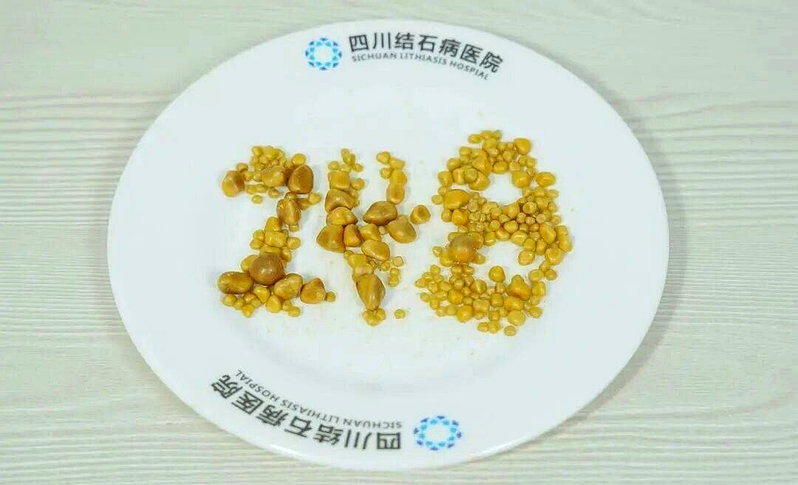 从江先生胆囊内取出的结石。(取材自环球网)