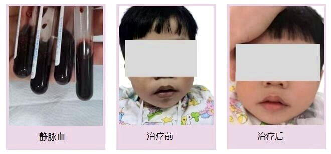 广东一名3岁男童小烨(化名)因长期食用隔夜剩饭剩菜,日前在学校被发现脸色与唇色莫...