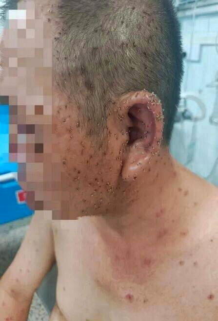湖北男子散步遭蜂群围攻,全身残留近千根毒刺。(取材自新晚报)