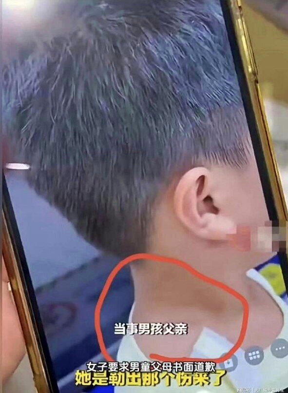 孩子被勒出瘀青。(视频截屏)