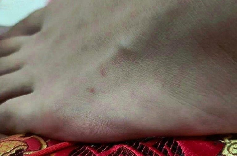 银环蛇钻进家门 闽男称「没被咬」 救助人员揪1细节救1命 林先生左脚的脚背上有两个红点。(取材自东南早报)