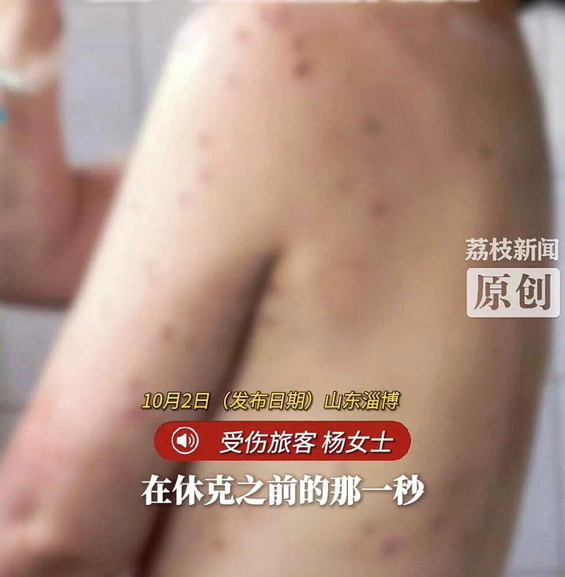 杨女士全身遭马蜂螫伤180多处，蜂群攻击时一度昏厥休克。（取材自荔枝新闻）