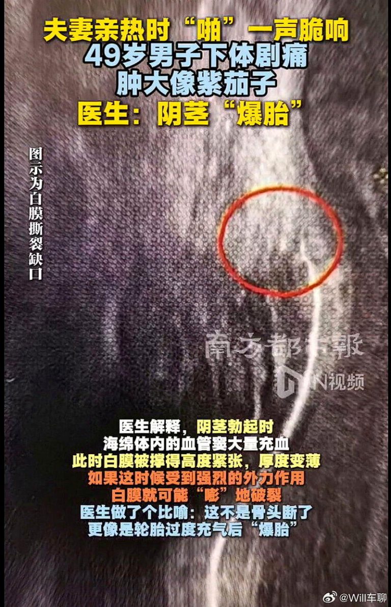 女上男下动作过激 49岁男「啪」一声 阴茎「爆胎」肿成茄子 季先生经检查是阴茎「爆胎」。(取材自南方都市报)