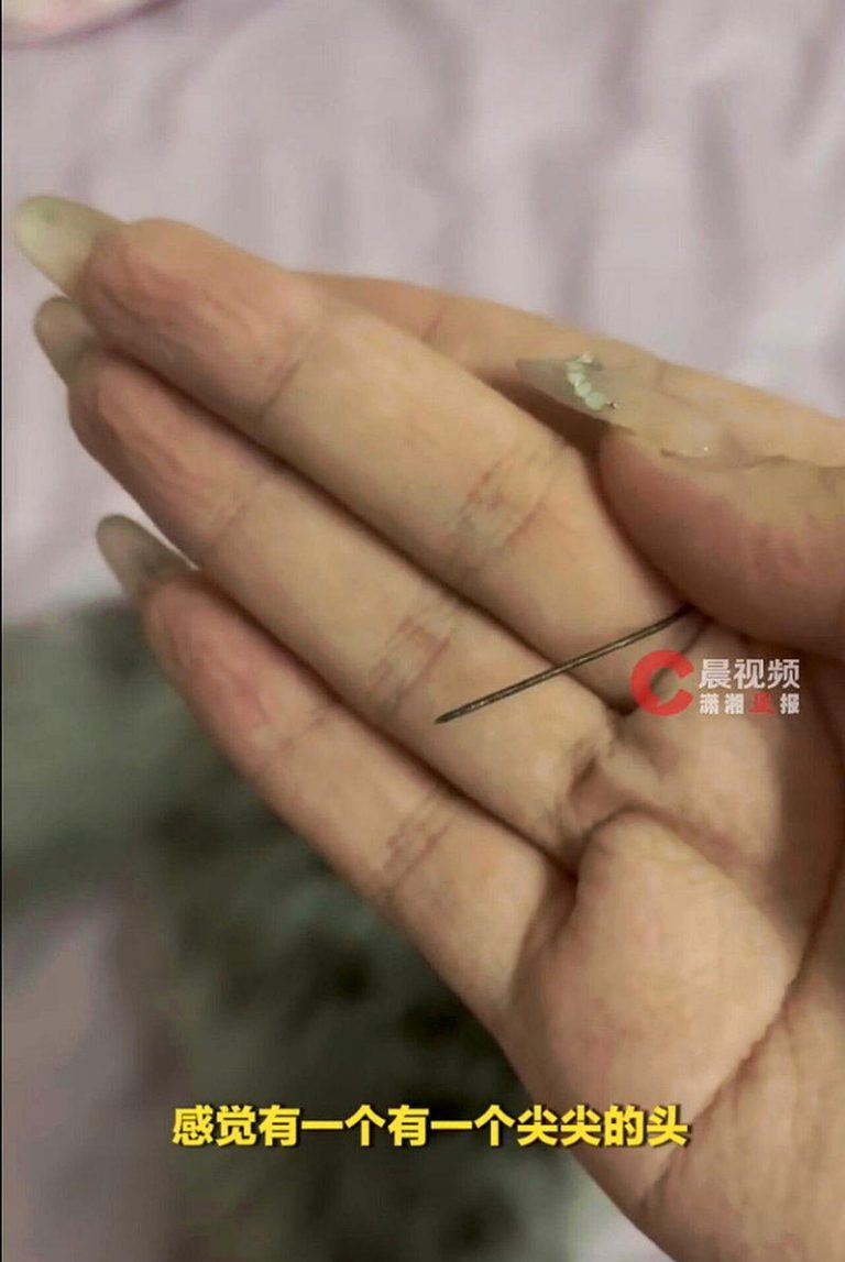 温州女左臀痛1个月 自己动手挤出5公分生锈针头 来源成谜 女子左臀剧痛一个月,竟自主挤出4公分「发黑锈针」。 (视频截屏)