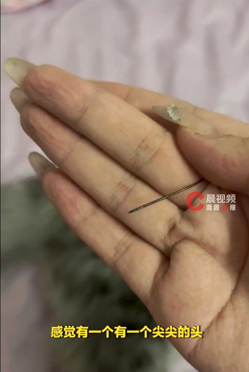 女子左臀剧痛一个月,竟自主挤出4公分「发黑锈针」。 (视频截屏)